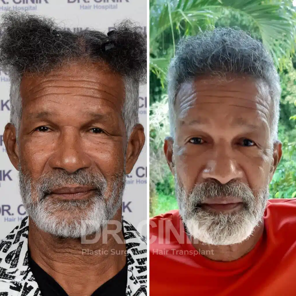 Before and after comparison of an Afro hair transplant with 3250 grafts, showing results 9 months post-procedure. Initial Norwood V pattern showcasing transformation.