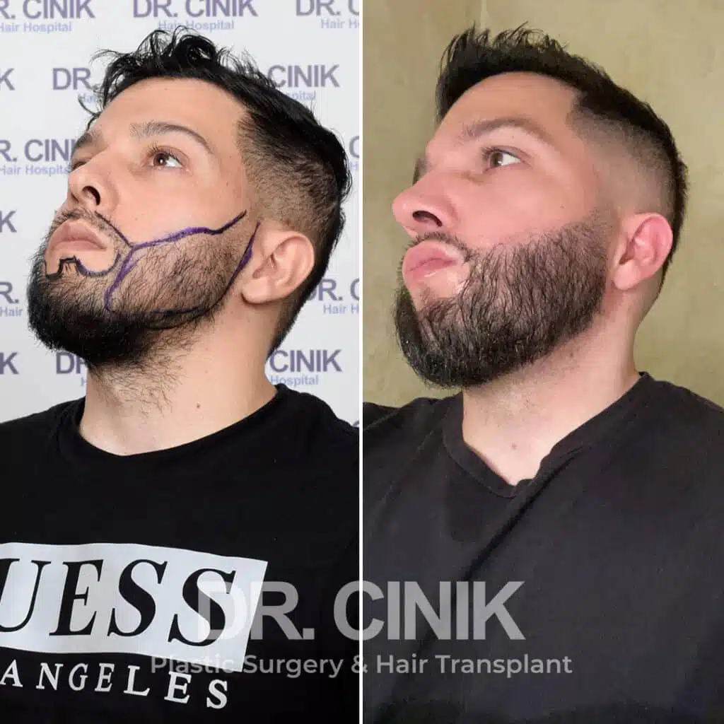 Before and after comparison of a beard hair transplant with 3000 grafts, showing results 10 months post-procedure. Initial sparse beard pattern showcasing transformation.