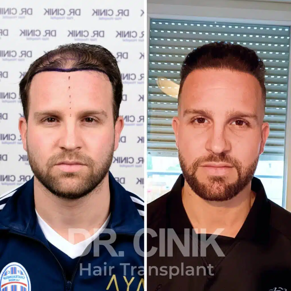 Before and after comparison of a FUE hair transplant with 4750 grafts, showing results 12 months post-procedure. Initial Norwood V pattern showcasing significant transformation.