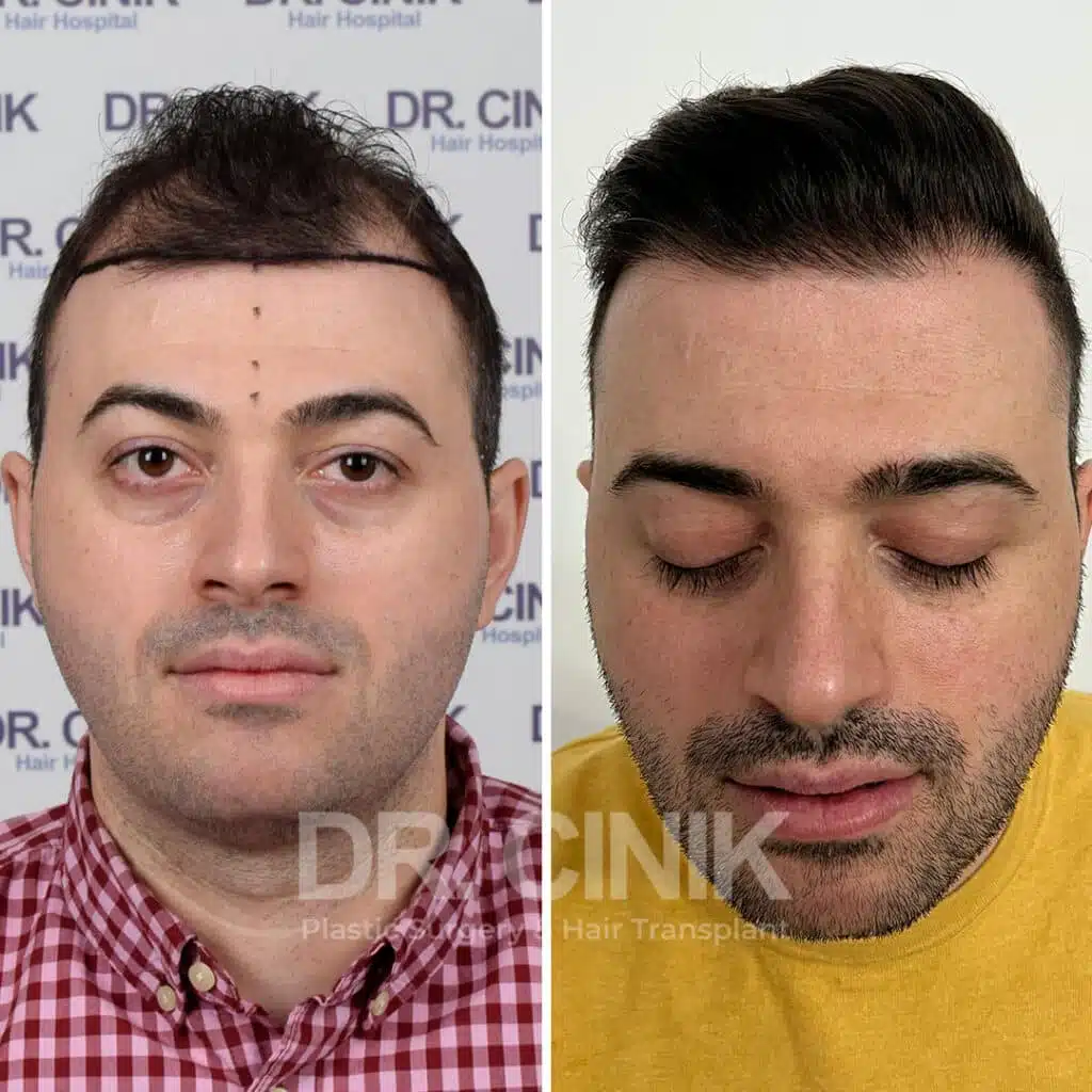Before and after comparison of a FUE Saphir hair transplant with 4200 grafts, showing results 10 months post-procedure. Initial Norwood V pattern showcasing transformation.