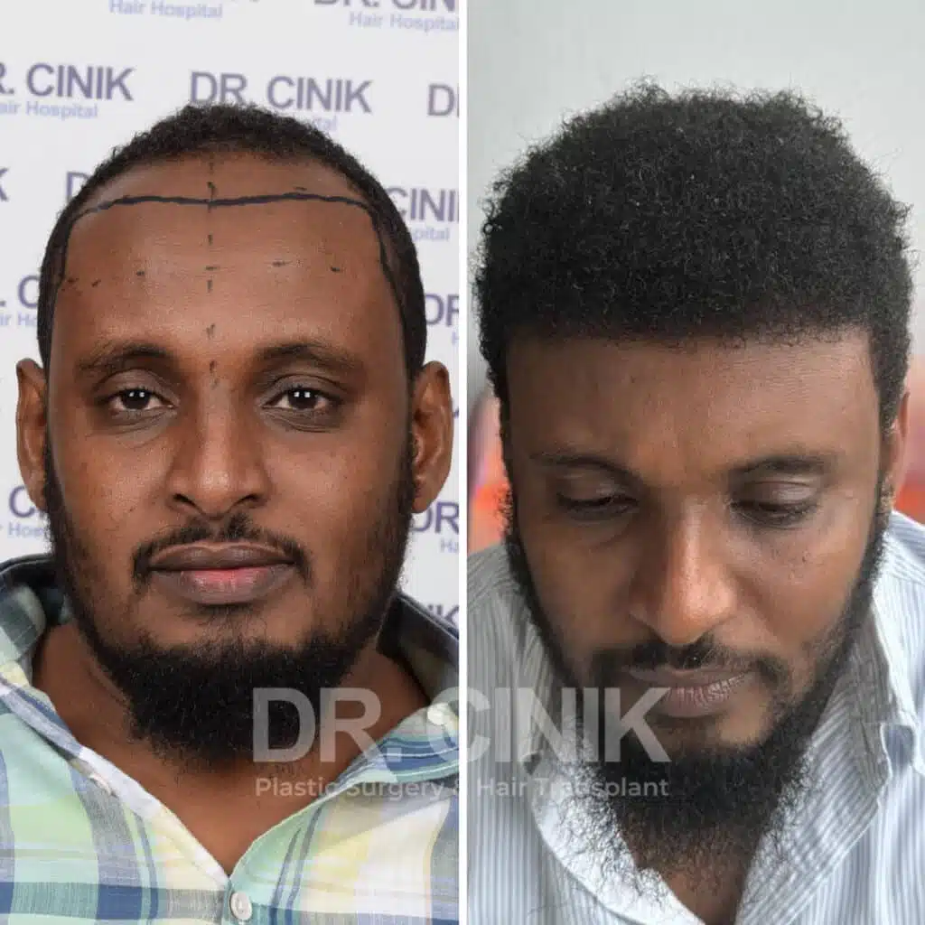 Before and after comparison of an Afro hair transplant with 3600 grafts, showing results 12 months post-procedure. Initial Norwood V pattern showcasing transformation.