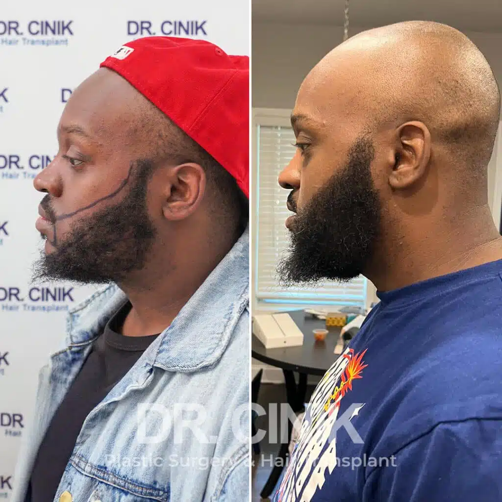 Before and after comparison of a beard hair transplant with 2400 grafts, showing results 9 months post-procedure. Initial sparse beard pattern showcasing transformation.