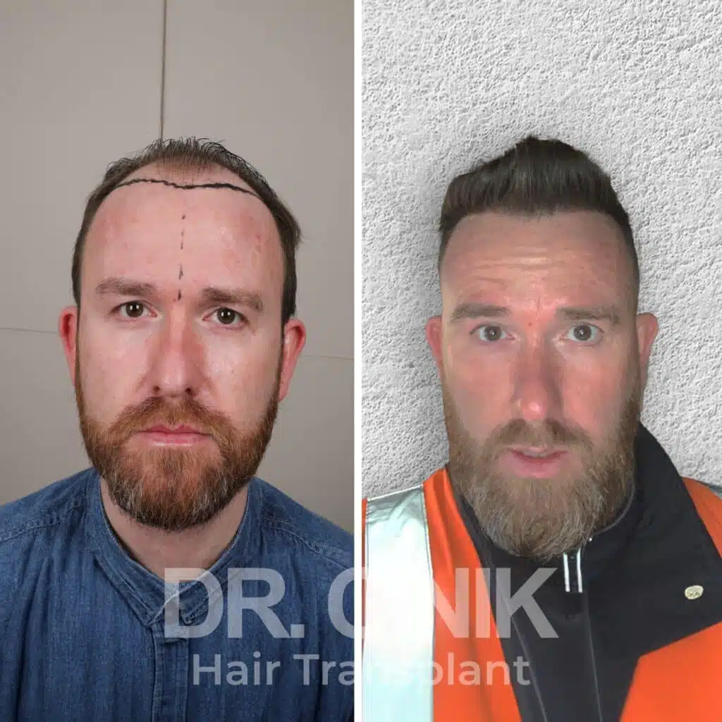 Before and after comparison of a FUE hair transplant with 4300 grafts, showing results 12 months post-procedure. Initial Norwood VI pattern showcasing significant transformation.