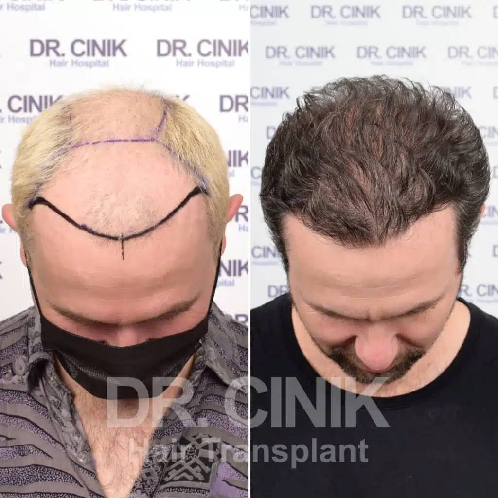 Before and after comparison of a FUE Saphir hair transplant with 4800 grafts, showing results 12 months post-procedure. Initial Norwood V pattern showcasing significant transformation.