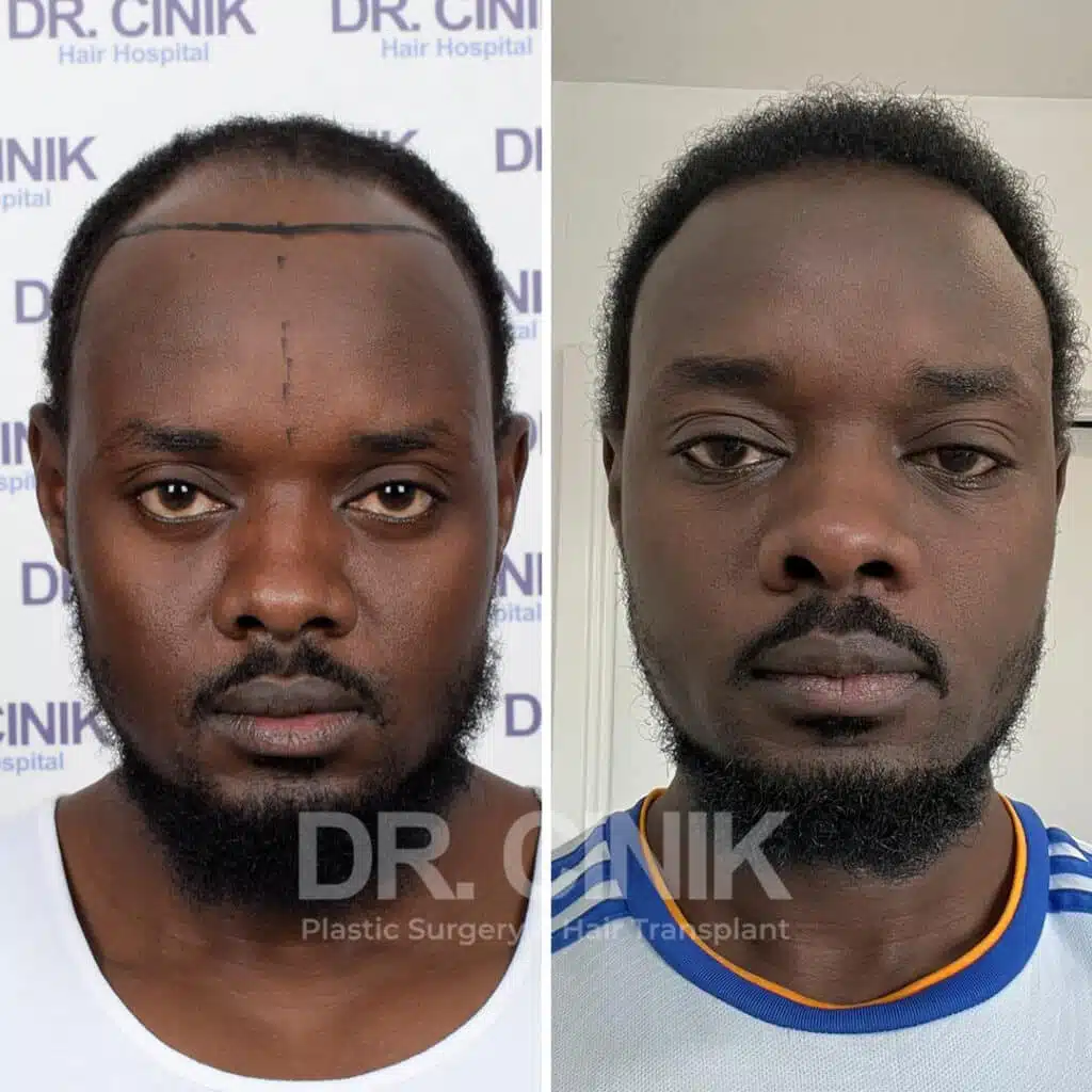 Aprs une greffe de cheveux : les consignes  suivre | DR. Cinik