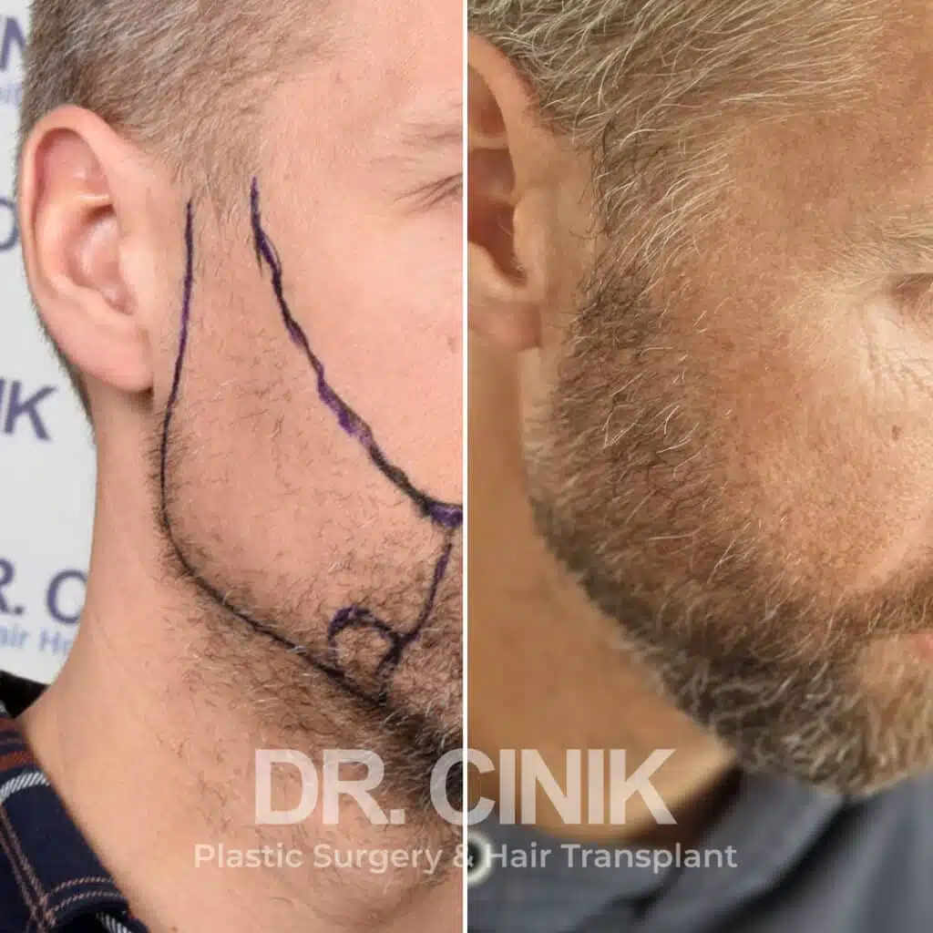 Before and after comparison of a beard hair transplant with 3100 grafts, showing results 9 months post-procedure. Initial beard transplant pattern showcasing transformation.