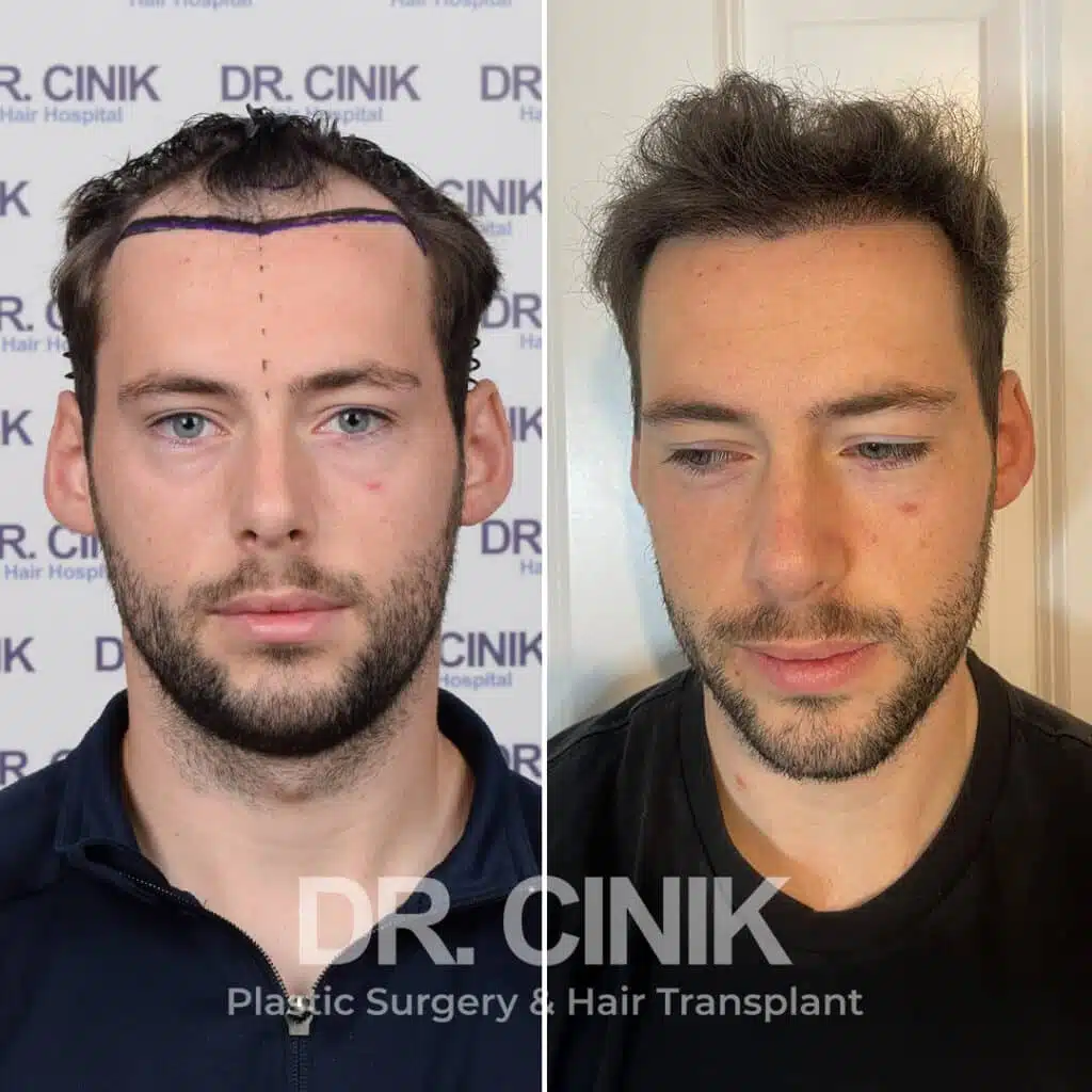 Before and after comparison of a DHI hair transplant with 2600 grafts, showing results 12 months post-procedure. Initial Norwood III pattern showcasing transformation.