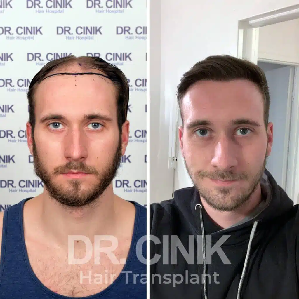 Before and after comparison of a FUE hair transplant with 5000 grafts, showing results 12 months post-procedure. Initial Norwood IV pattern showcasing significant hair restoration.