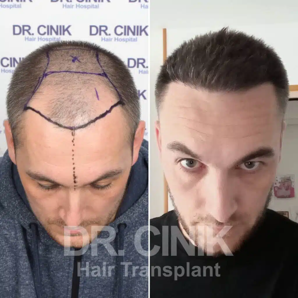 Before and after comparison of a FUE Saphir hair transplant with 3800 grafts, showing results 12 months post-procedure. Initial Norwood V pattern showcasing transformation.
