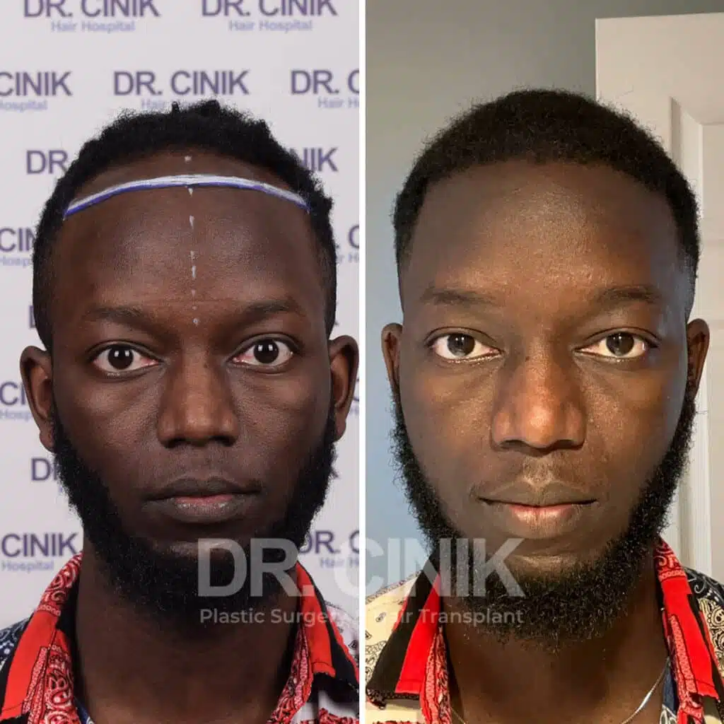Before and after comparison of an Afro hair transplant with 3000 grafts, showing results 9 months post-procedure. Initial Norwood IV pattern showcasing transformation.