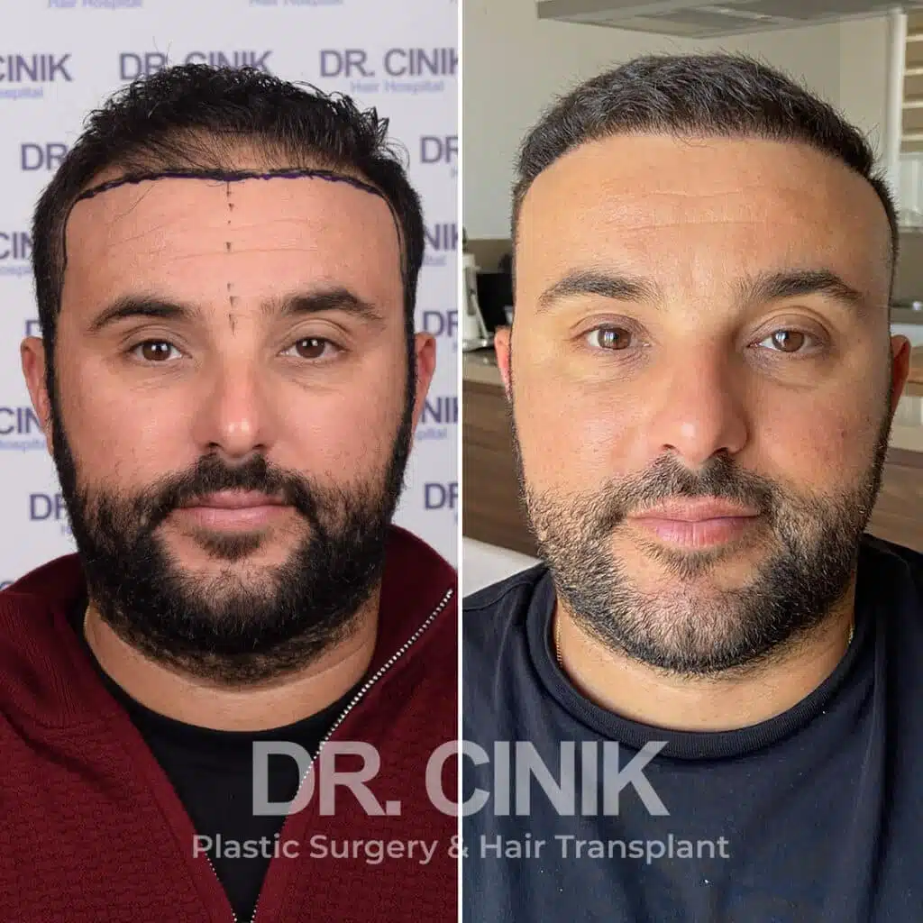 Before and after comparison of a DHI hair transplant with 3400 grafts, showing results 12 months post-procedure. Initial Norwood V pattern showcasing significant transformation.