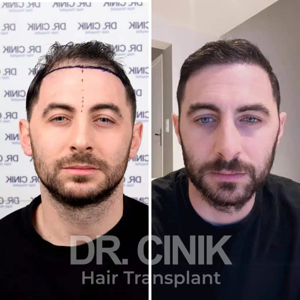 Before and after comparison of a FUE hair transplant with 4450 grafts, showing results 12 months post-procedure. Initial Norwood V pattern showcasing transformation.