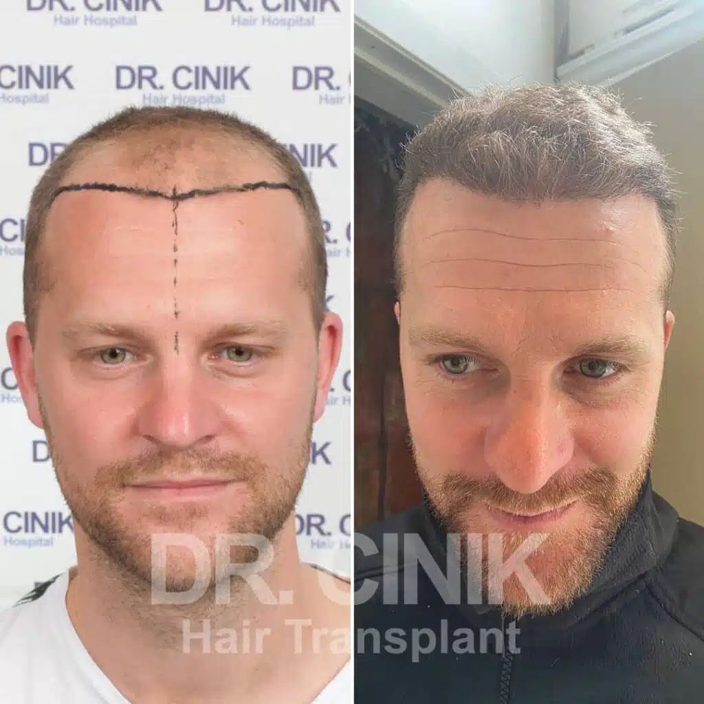 Before and after comparison of a FUE Saphir hair transplant with 3950 grafts, showing results 12 months post-procedure. Initial Norwood V pattern showcasing transformation.