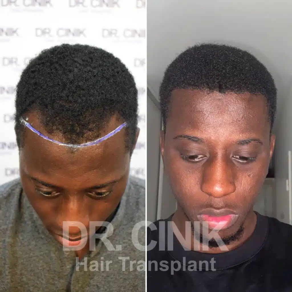 Before and after comparison of an Afro hair transplant with 3050 grafts, showing results 9 months post-procedure. Initial Norwood III pattern showcasing transformation.