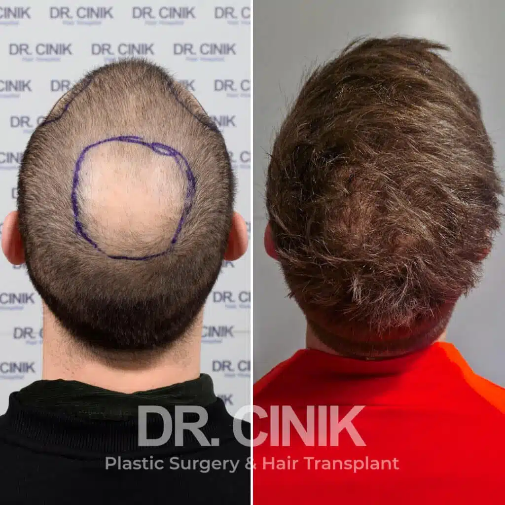 Before and after comparison of a DHI hair transplant with 3000 grafts, showing results 9 months post-procedure. Initial Norwood V pattern showcasing significant transformation.