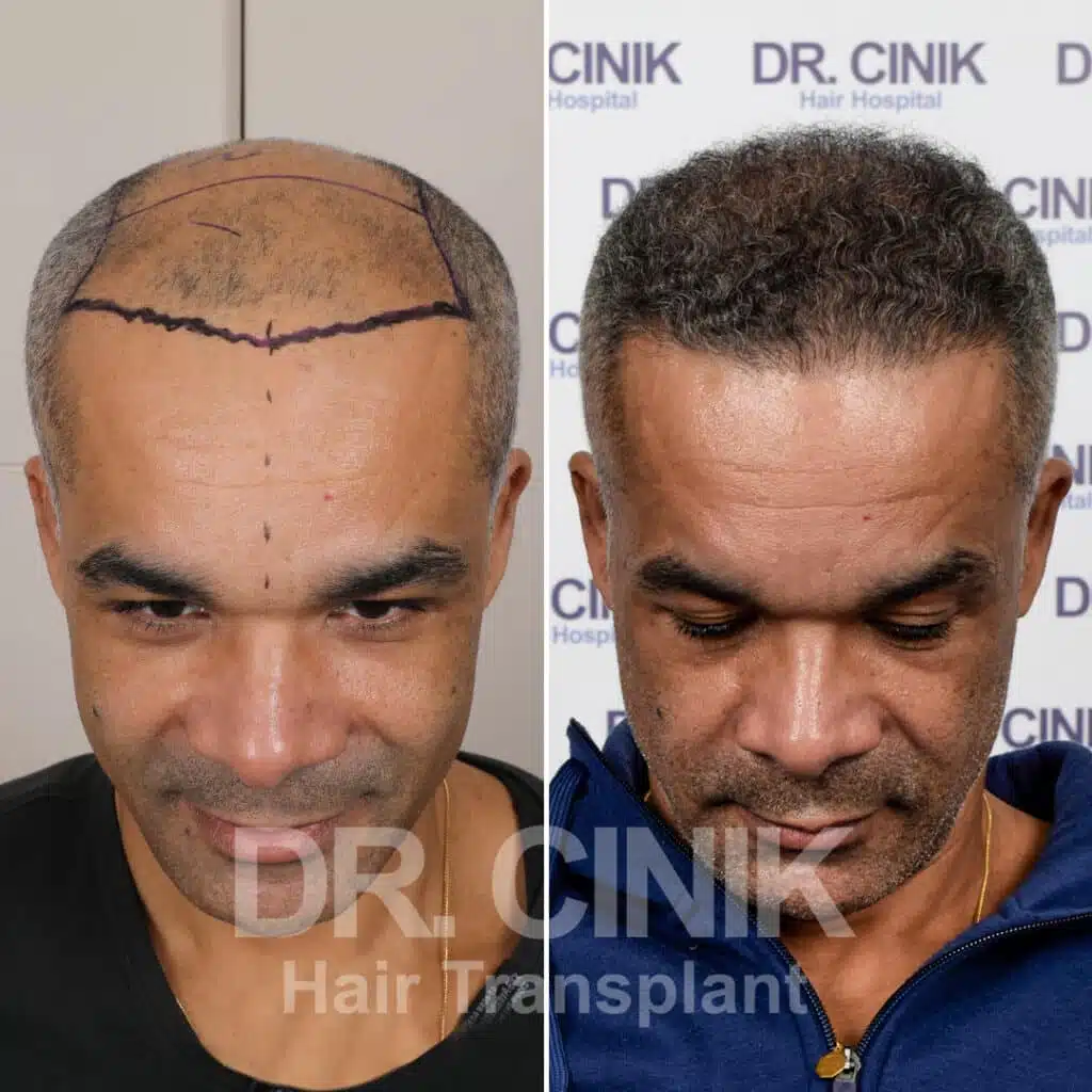 Before and after comparison of a FUE Saphir hair transplant with 4600 grafts, showing results 12 months post-procedure. Initial Norwood VI pattern showcasing significant transformation.