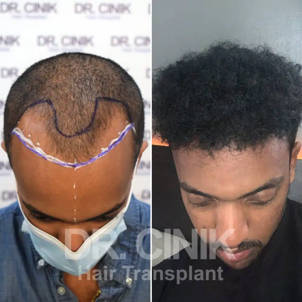 Before and after comparison of an Afro hair transplant with 3800 grafts, showing results 12 months post-procedure. Initial Norwood V pattern showcasing transformation.