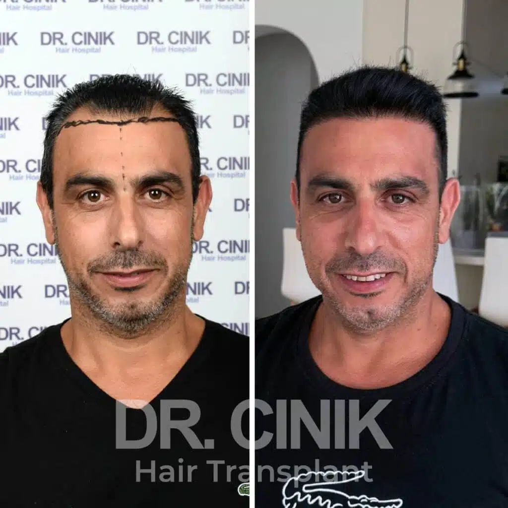 Before and after comparison of a FUE hair transplant with 3700 grafts, showing results 12 months post-procedure. Initial Norwood V pattern showcasing significant transformation.