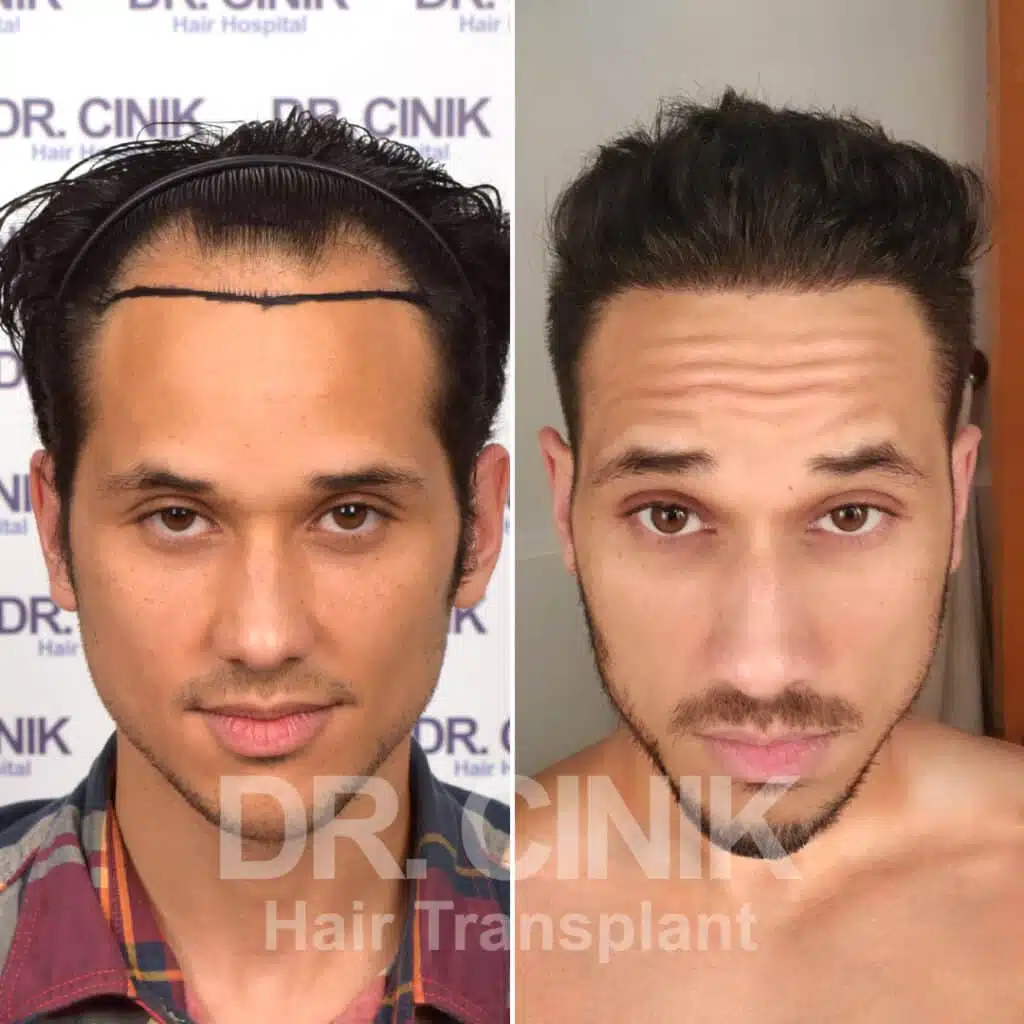 Before and after comparison of a FUE Saphir hair transplant with 3280 grafts, showing results 12 months post-procedure. Initial Norwood V pattern showcasing transformation.
