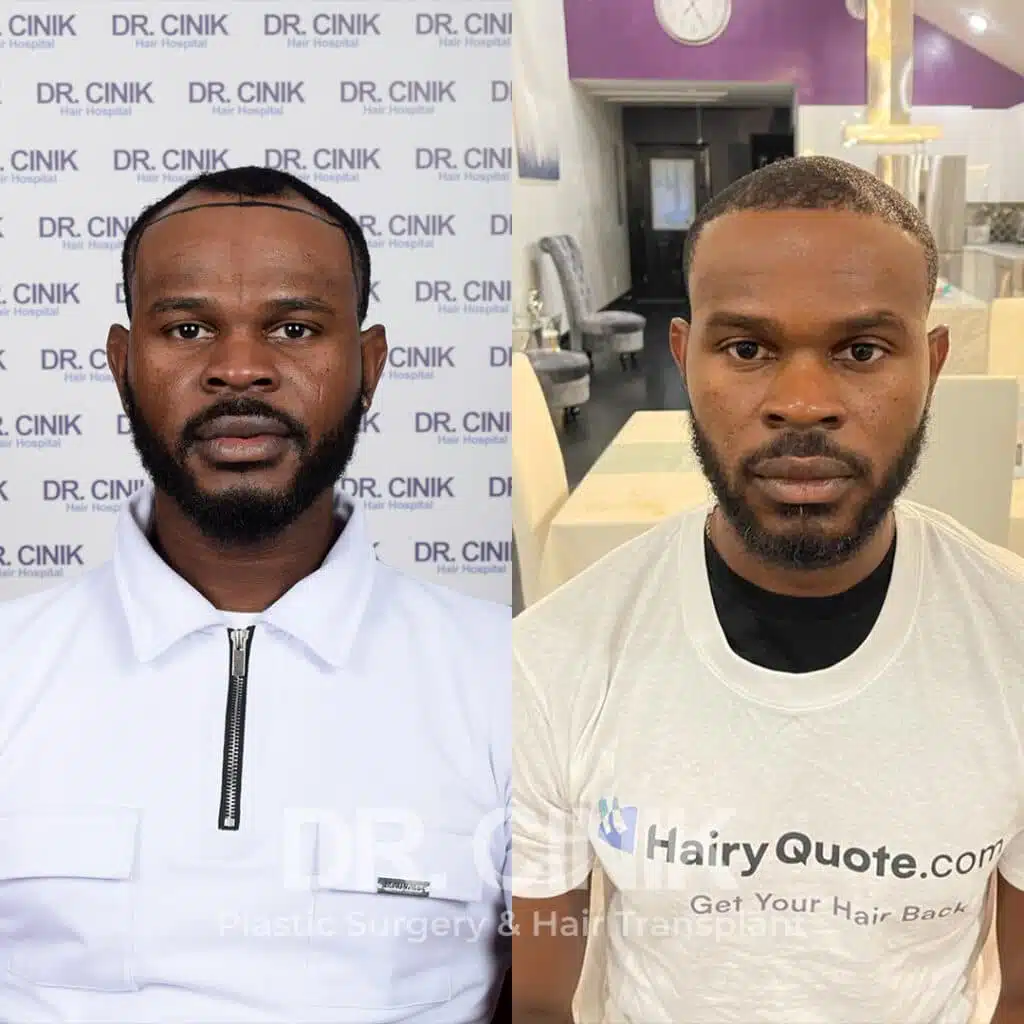 Before and after comparison of an Afro hair transplant with 2900 grafts, showing results 9 months post-procedure. Initial Norwood III pattern showcasing transformation.