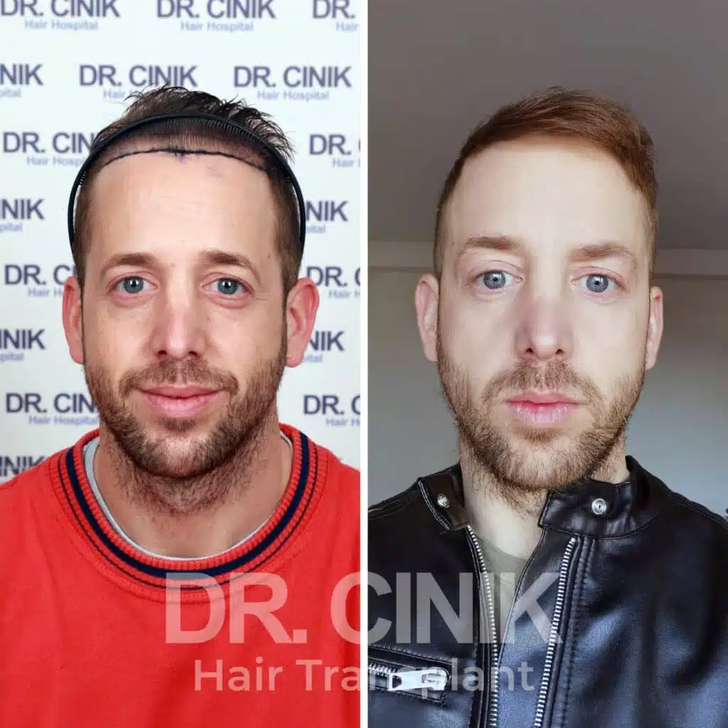 Before and after comparison of a FUE hair transplant with 4015 grafts, showing results 12 months post-procedure. Initial Norwood V pattern showcasing significant transformation.