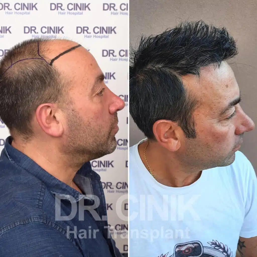 Before and after comparison of a FUE Saphir hair transplant with 4750 grafts, showing results 9 months post-procedure. Initial Norwood V pattern showcasing transformation.