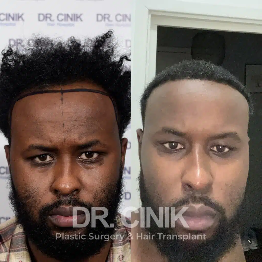 Before and after comparison of an Afro hair transplant with 3450 grafts, showing results 12 months post-procedure. Initial Norwood IV pattern showcasing transformation.