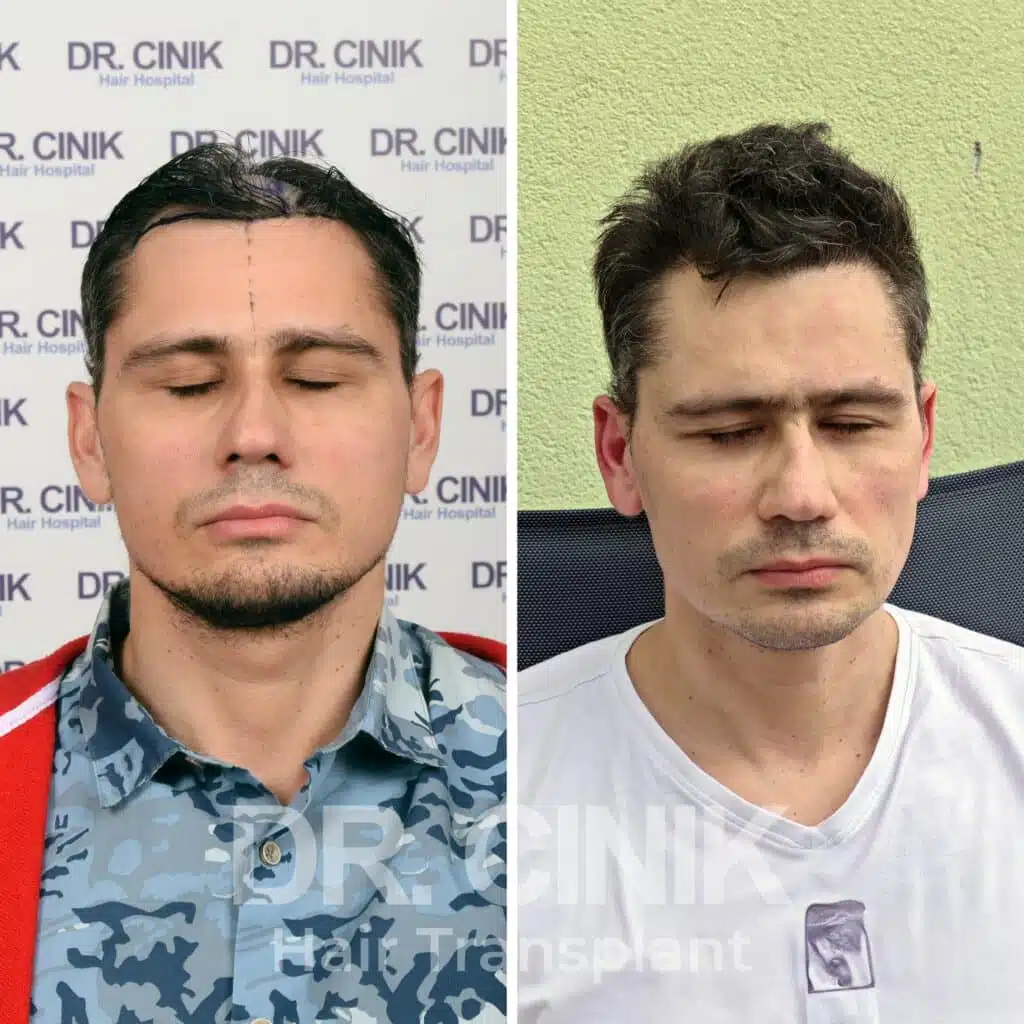 Before and after comparison of a FUE hair transplant with 3500 grafts, showing results 12 months post-procedure. Initial Norwood V pattern showcasing significant transformation.