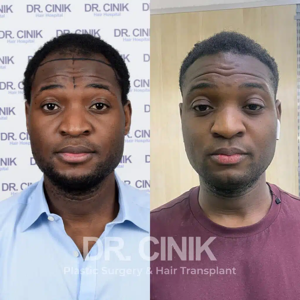 Before and after comparison of an Afro hair transplant with 3000 grafts, showing results 12 months post-procedure. Initial Norwood IV pattern showcasing transformation.