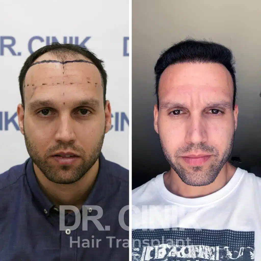 Before and after comparison of a DHI hair transplant with 4250 grafts, showing results 12 months post-procedure. Initial Norwood V pattern showcasing significant transformation.