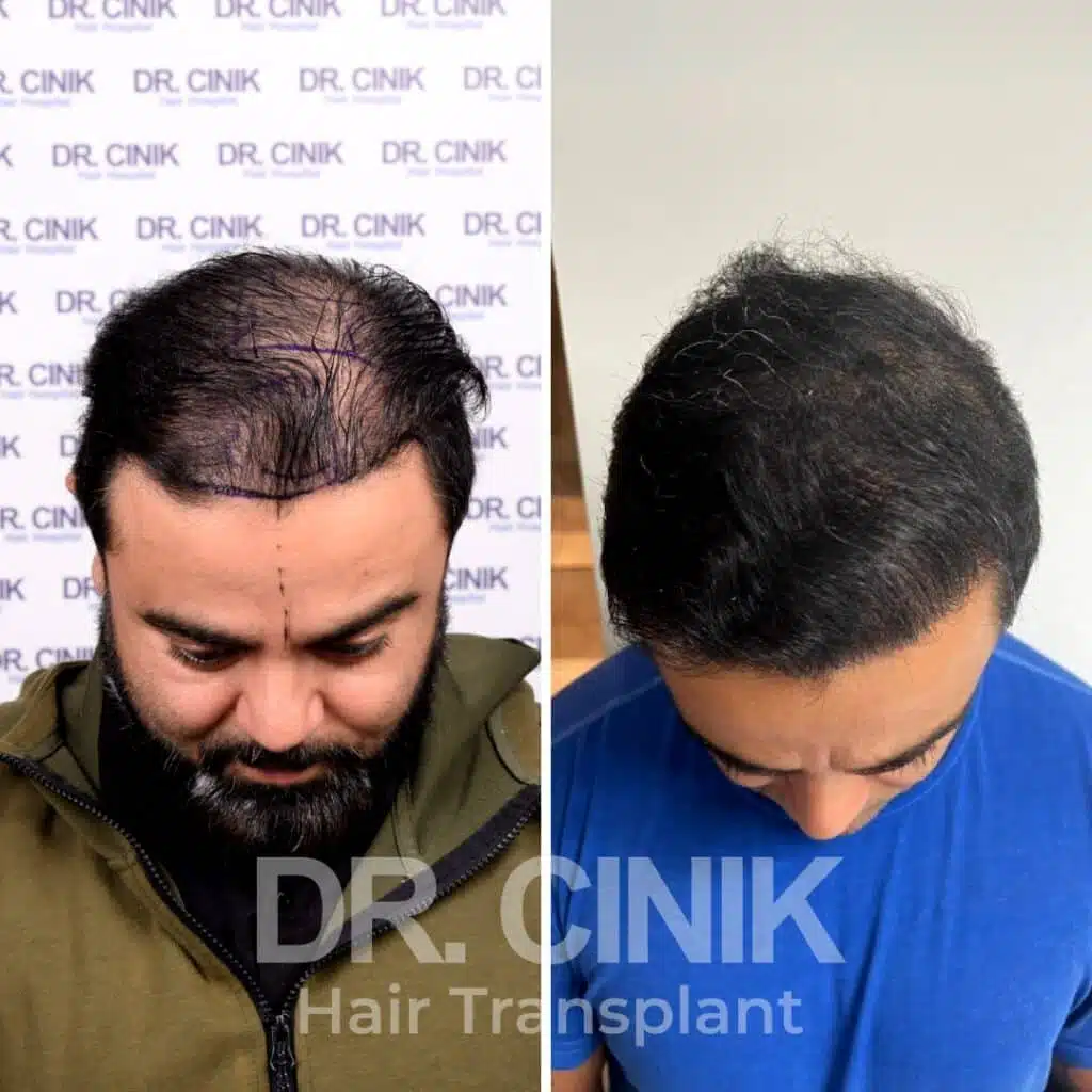 Before and after comparison of a FUE hair transplant with 4300 grafts, showing results 12 months post-procedure. Initial Norwood IV pattern showcasing transformation.