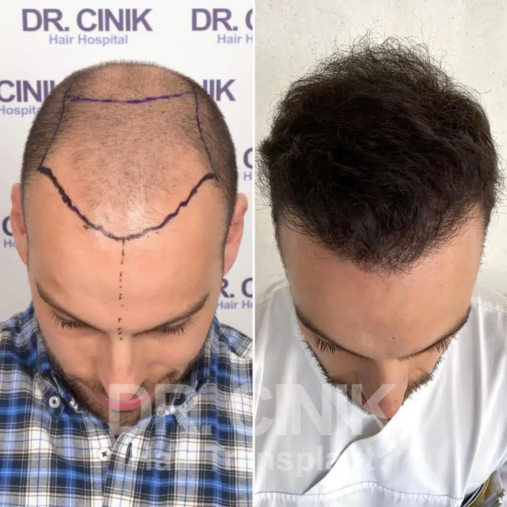 Before and after comparison of a FUE Saphir hair transplant with 4000 grafts, showing results 9 months post-procedure. Initial Norwood V pattern showcasing significant transformation.