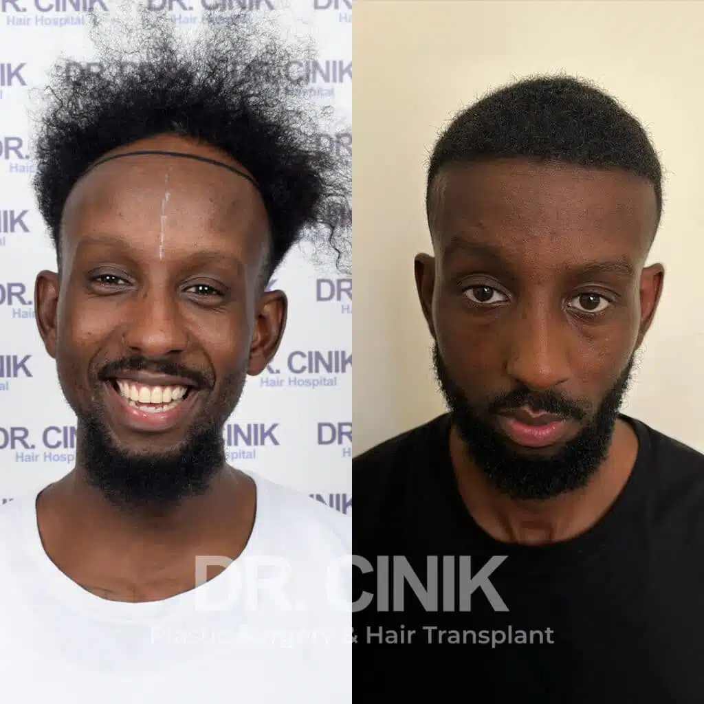 Before and after comparison of an Afro hair transplant with 3600 grafts, showing results 12 months post-procedure. Initial Norwood IV pattern showcasing transformation.