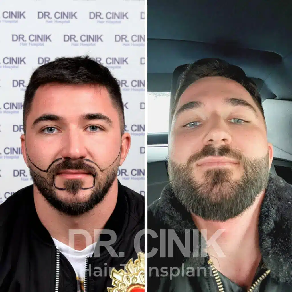 Before and after comparison of a DHI hair transplant with 2400 grafts, showing results 12 months post-procedure. Initial beard transplant showcasing facial hair transformation.