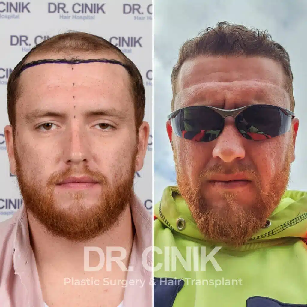 Before and after comparison of a FUE hair transplant with 3900 grafts, showing results 10 months post-procedure. Initial Norwood V pattern showcasing significant transformation.