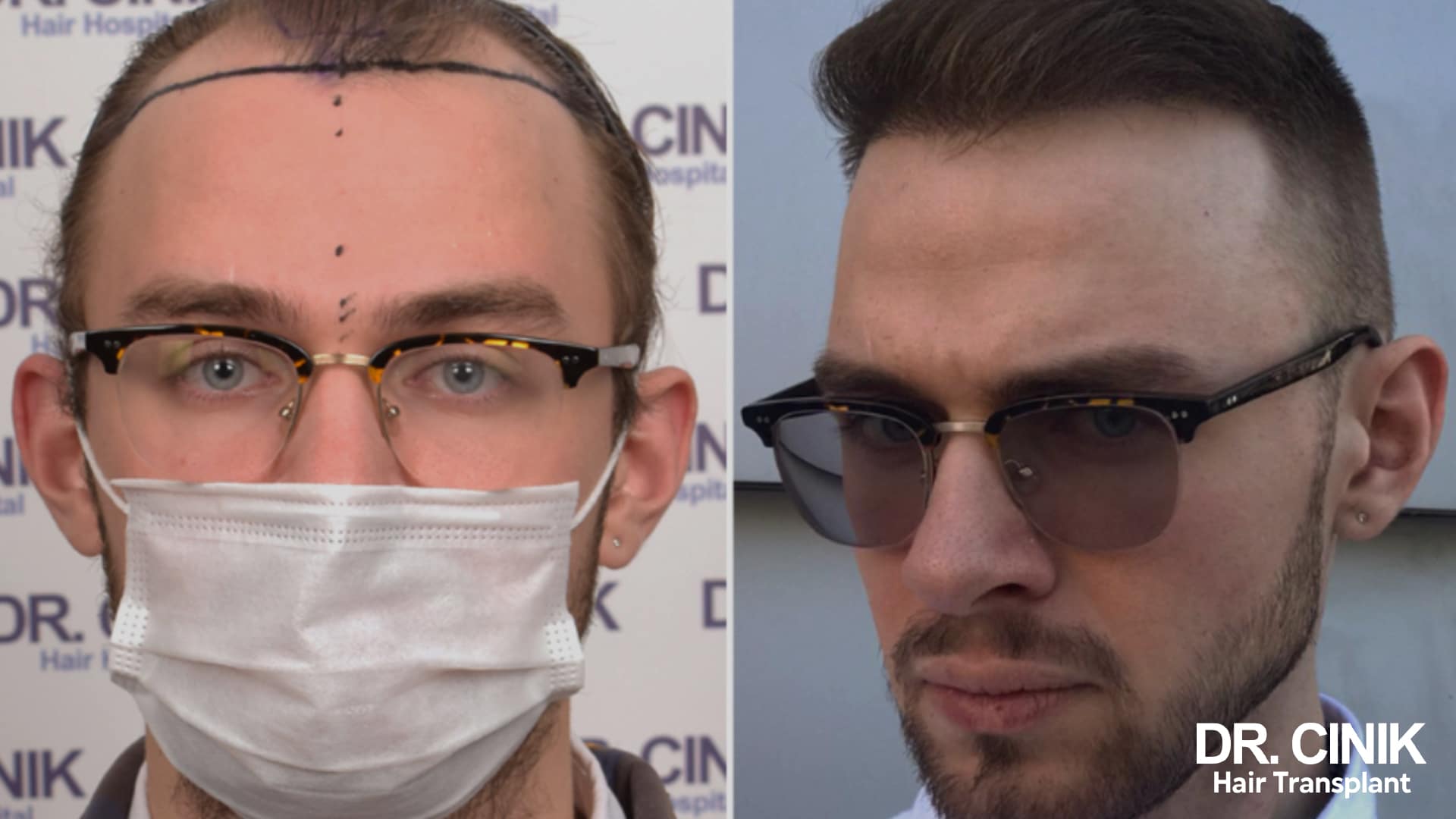 Greffe de cheveux : résultats après 1 an – Dr Cinik