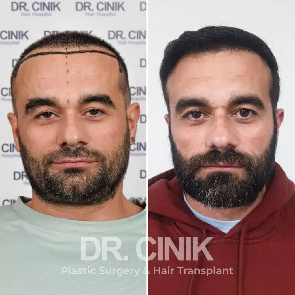 Before and after comparison of a FUE hair transplant with 3500 grafts, showing results 12 months post-procedure. Initial Norwood V pattern showcasing significant transformation.