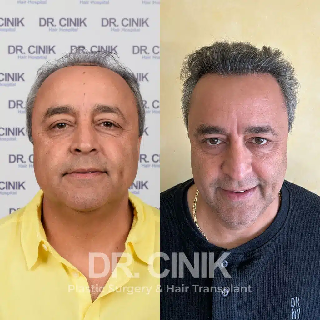 Before and after comparison of a FUE Saphir hair transplant with 3800 grafts, showing results 12 months post-procedure. Initial Norwood VI pattern showcasing transformation.