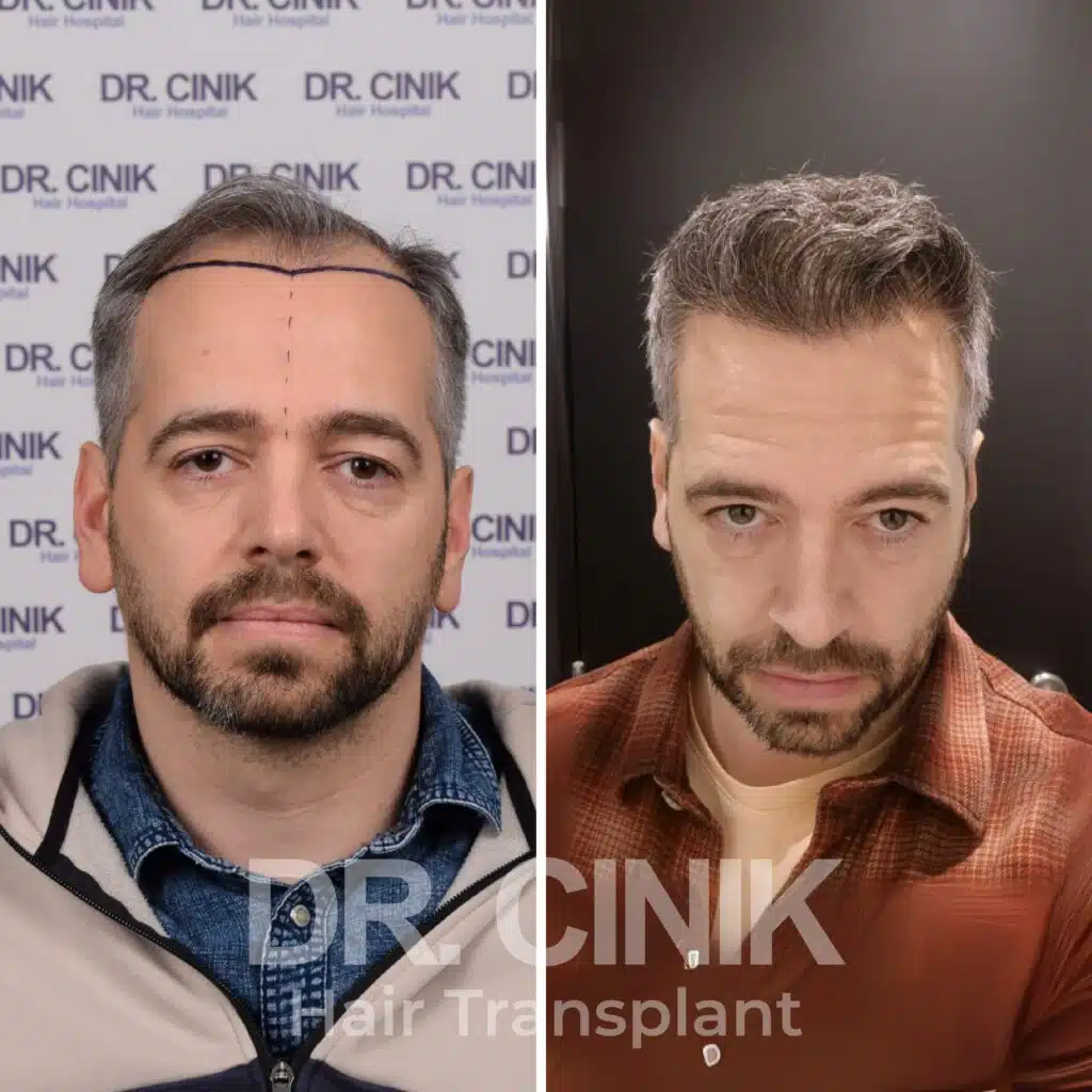 Before and after comparison of a DHI hair transplant with 4780 grafts, showing results 12 months post-procedure. Initial Norwood V pattern showcasing significant transformation.