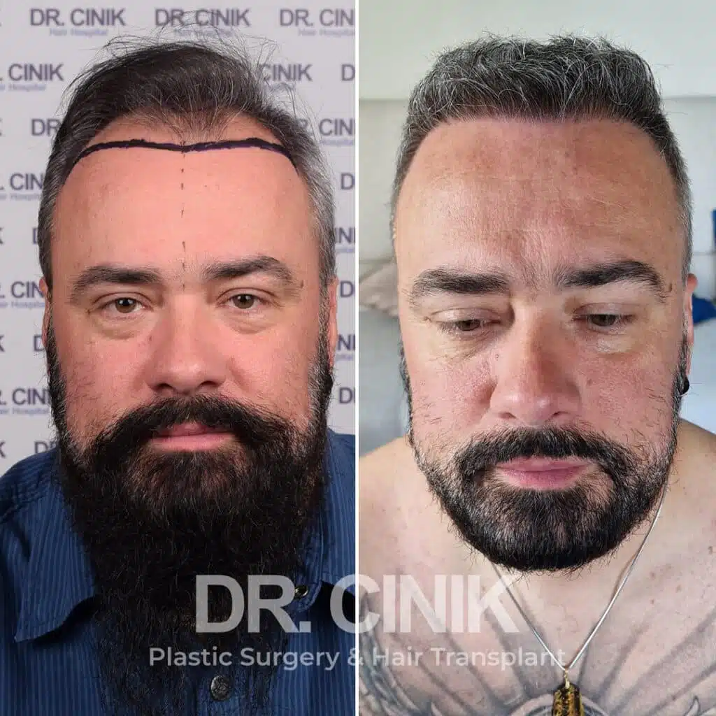 Before and after comparison of a FUE hair transplant with 3000 grafts, showing results 12 months post-procedure. Initial Norwood V pattern showcasing significant transformation.