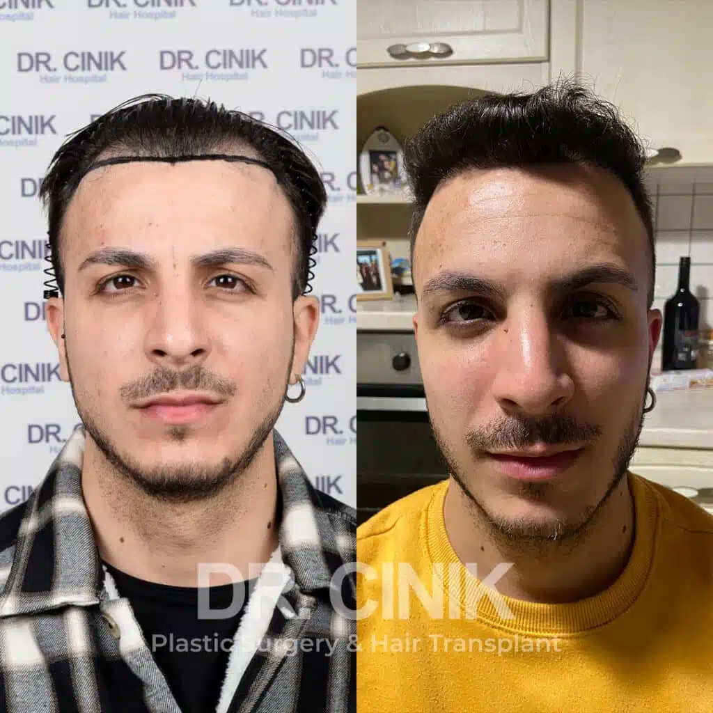 Before and after comparison of a FUE Saphir hair transplant with 3500 grafts, showing results 9 months post-procedure. Initial Norwood V pattern showcasing transformation.