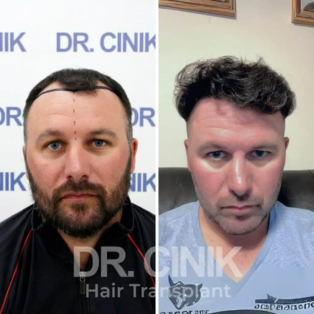 Before and after comparison of a DHI hair transplant with 4400 grafts, showing results 12 months post-procedure. Initial Norwood V pattern showcasing significant transformation.