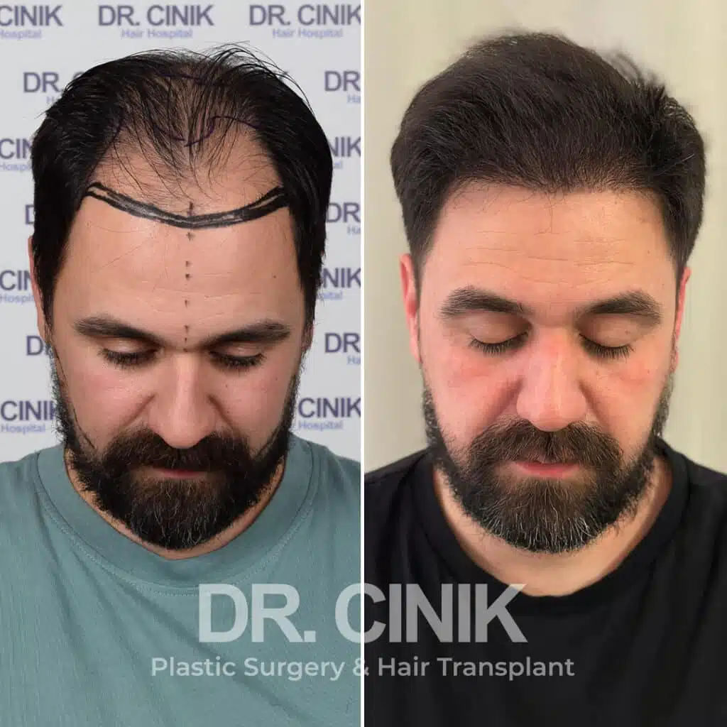 Before and after comparison of a FUE hair transplant with 4500 grafts, showing results 11 months post-procedure. Initial Norwood V pattern showcasing significant transformation.