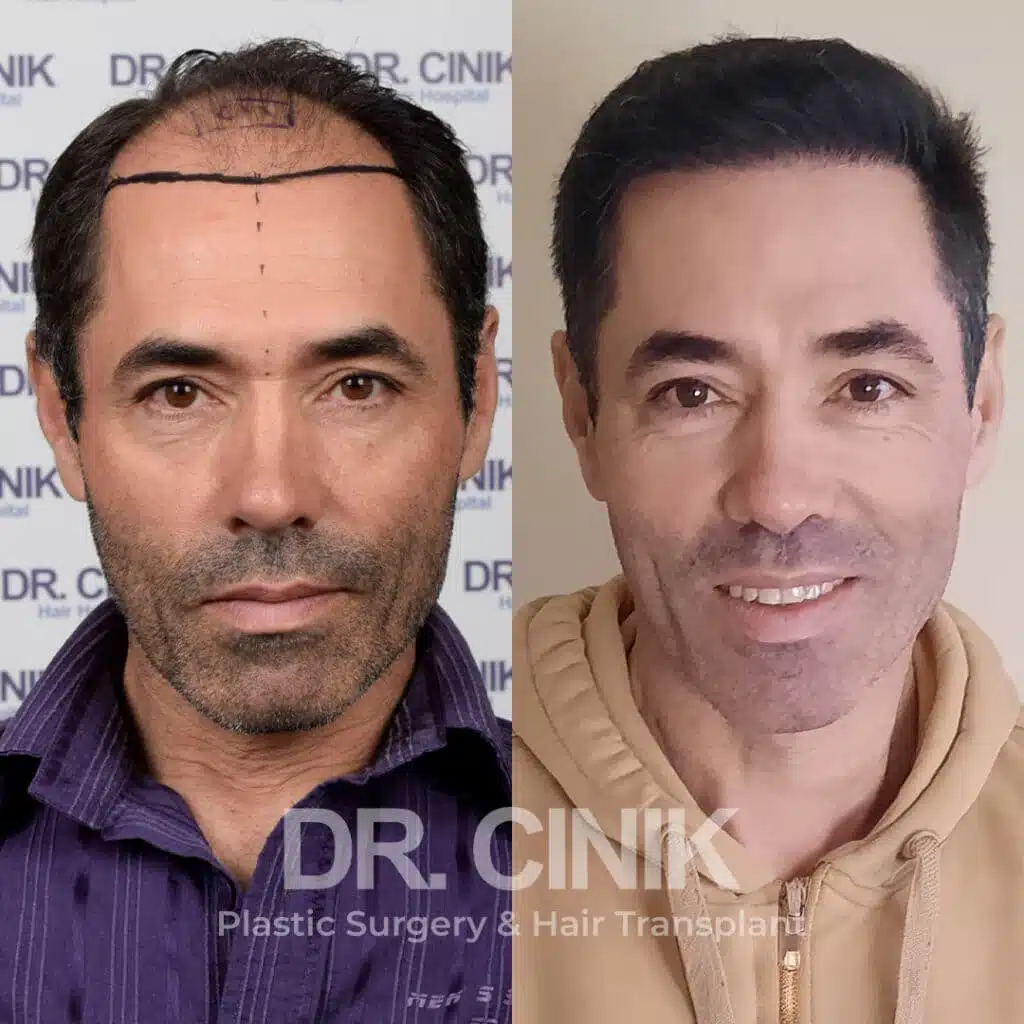 Before and after comparison of a FUE Saphir hair transplant with 4600 grafts, showing results 9 months post-procedure. Initial Norwood V pattern showcasing significant transformation.