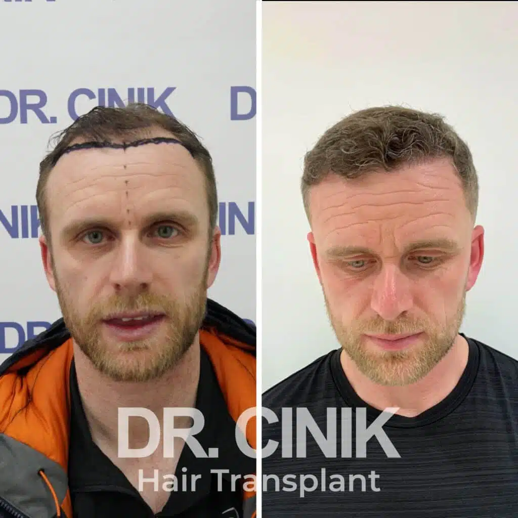 Before and after comparison of a DHI hair transplant with 4750 grafts, showing results 12 months post-procedure. Initial Norwood V pattern showcasing significant transformation.