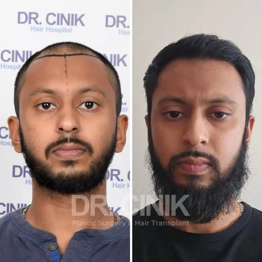 Before and after comparison of a FUE hair transplant with 4150 grafts, showing results 9 months post-procedure. Initial Norwood V pattern showcasing significant transformation.