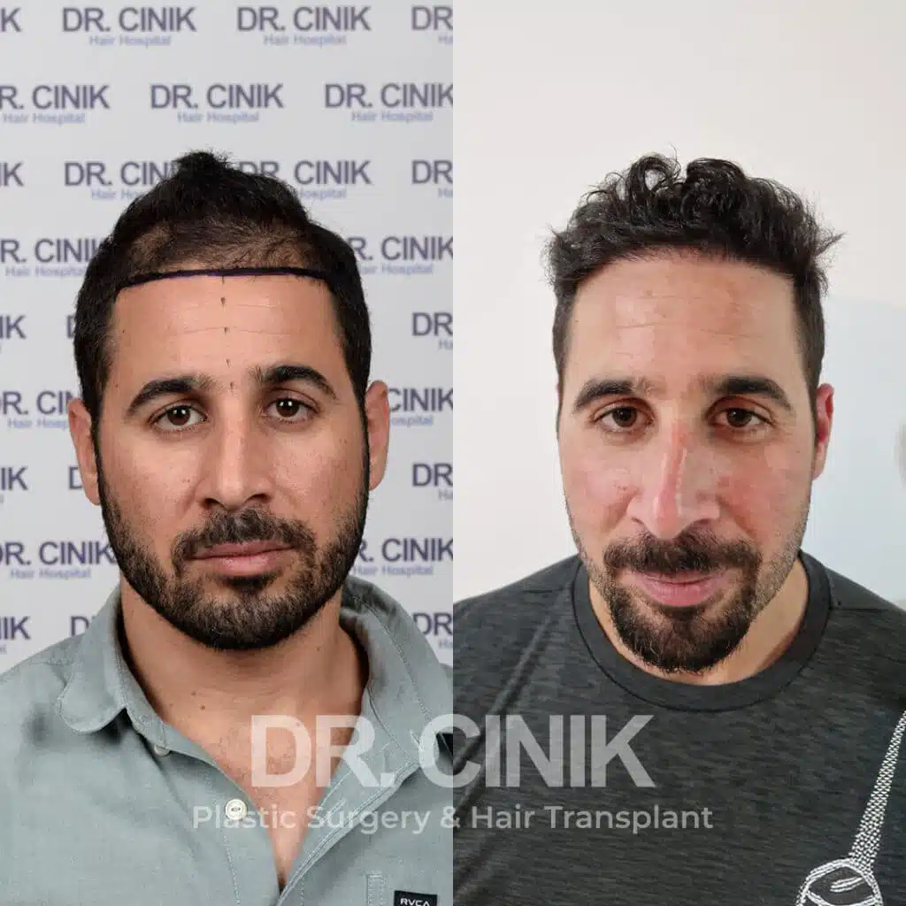 Before and after comparison of a FUE Saphir hair transplant with 3100 grafts, showing results 12 months post-procedure. Initial Norwood V pattern showcasing transformation.