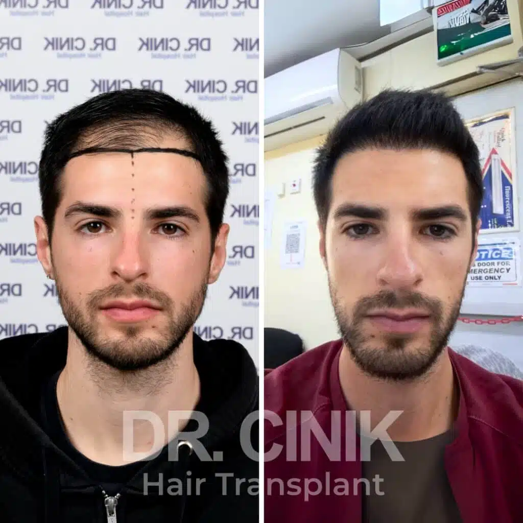Before and after comparison of a DHI hair transplant with 3100 grafts, showing results 12 months post-procedure. Initial Norwood V pattern showcasing significant transformation.