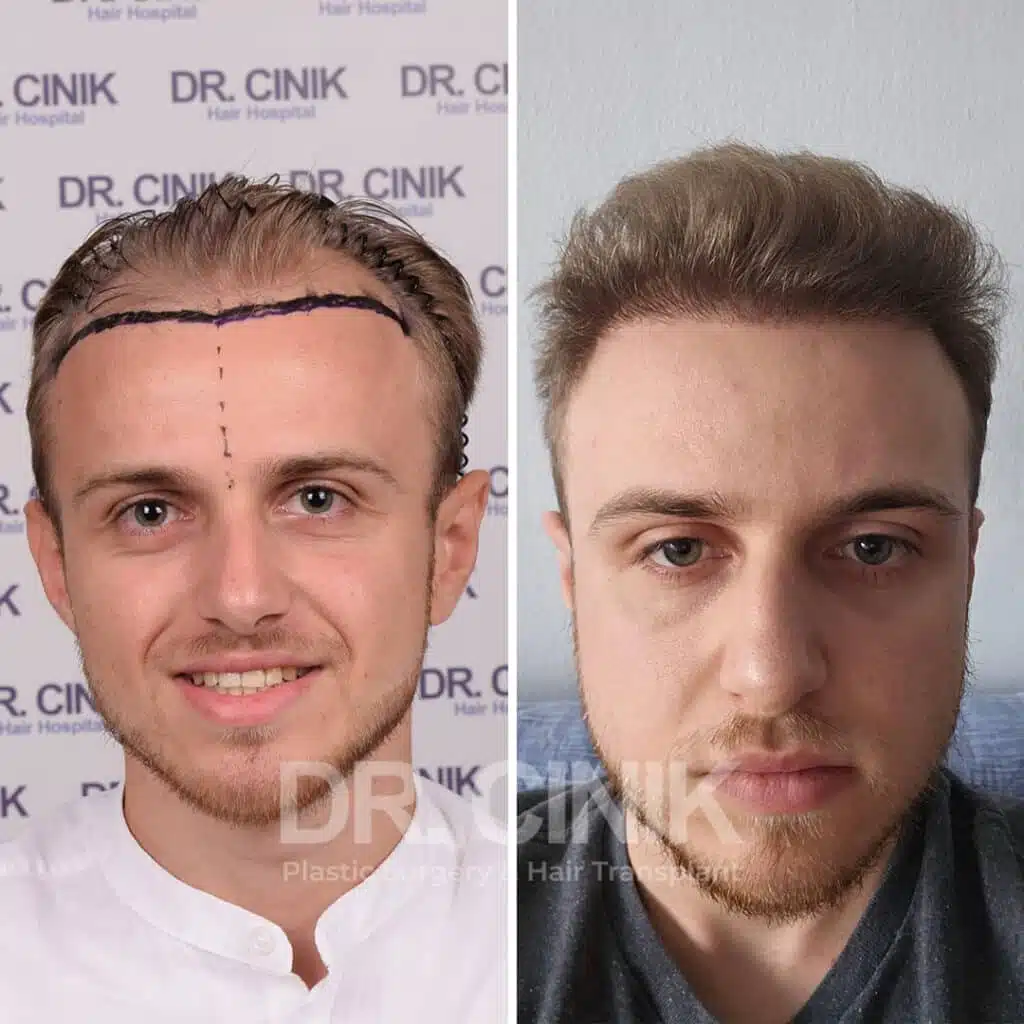 Before and after comparison of a FUE hair transplant with 4200 grafts, showing results 6 months post-procedure. Initial Norwood V pattern showcasing significant transformation.