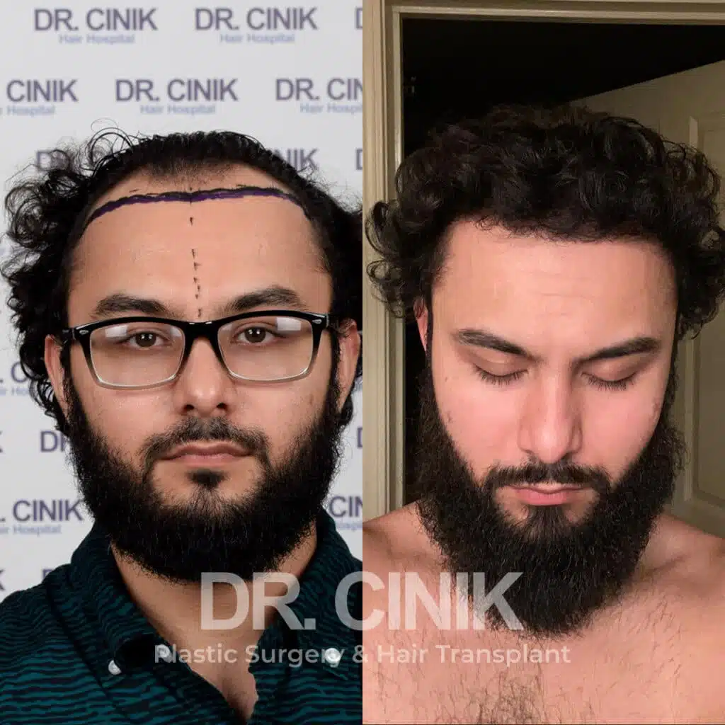 Before and after comparison of a FUE Saphir hair transplant with 3000 grafts, showing results 9 months post-procedure. Initial Norwood V pattern showcasing significant transformation.